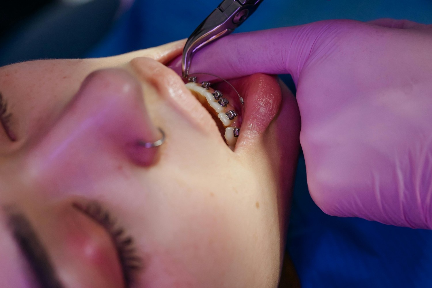 Invisalign Treatment